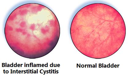 Urodynamics and Interstitial Cystitis