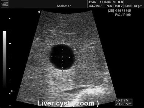 MEDISON.RU - Liver cyst, zoom (№159, SA-9900)