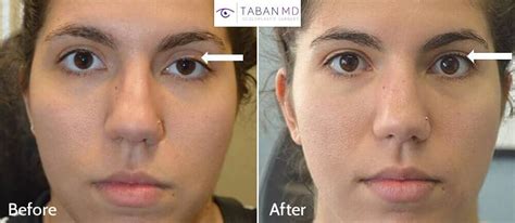 Eyelid Ptosis Before and After Gallery | Taban MD