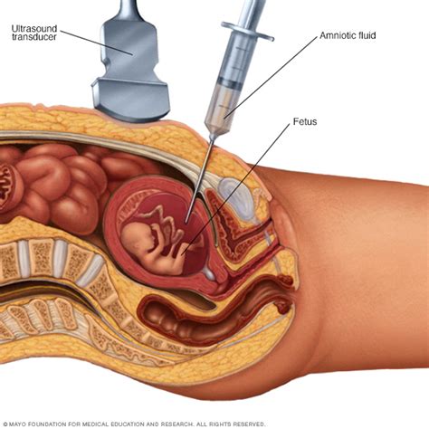 Amniocentesis | Beacon Health System