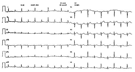 Electrical alternans