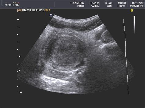 Three 843 Ovarian Fibroma Ultrasound | WSOURCE