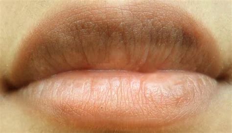 Lip Discoloration Red Spot | Ownerlip.co