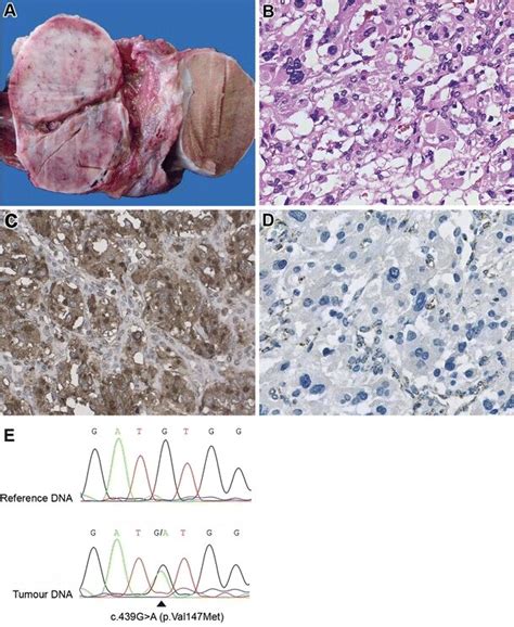 a Gross aspect of spermatic cord paraganglioma. b Typical histology of... | Download Scientific ...