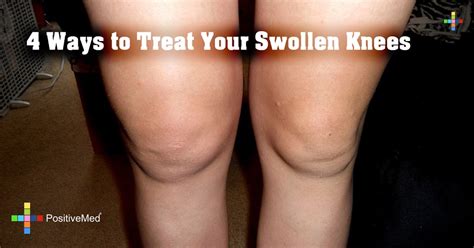 4 Ways to Treat Your Swollen Knees - PositiveMed