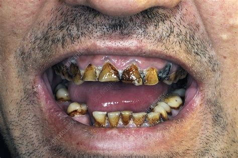 Nicotine stained and decayed teeth - Stock Image - C016/6970 - Science ...