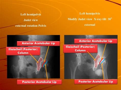 The modification plain radiographic of pelvis