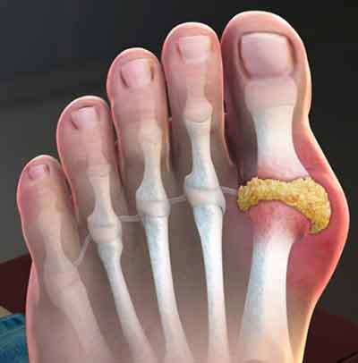 What Is Gout in Foot | Symptoms & Treatment Podiatrist Orange County Irvine