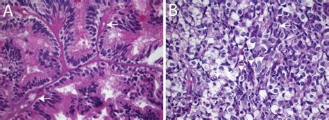 Choroid Plexus Tumors | Basicmedical Key