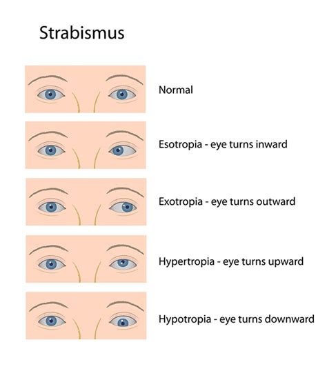 Strabismus Midtown | Crossed Eyes in NYC | 10017 Cross Eyes