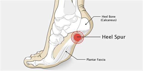 Calcaneal Spurs Treatment in Gurgaon | Heel Pain Treatment Gurgaon