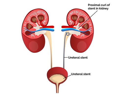 Best Double J Stent Removal Procedure at Treatians