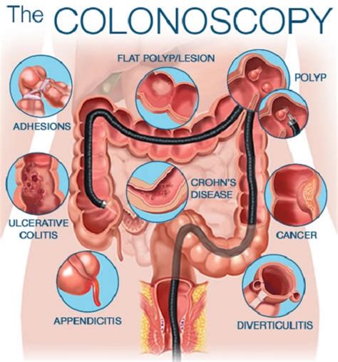 Difference between Sigmoidoscopy and Colonoscopy | Difference Between