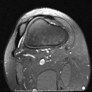 Axial T2 MRI of the right knee in a patient with a hypoplastic and ...