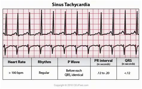 Sinus Tachycardia Vs Atrial Flutter