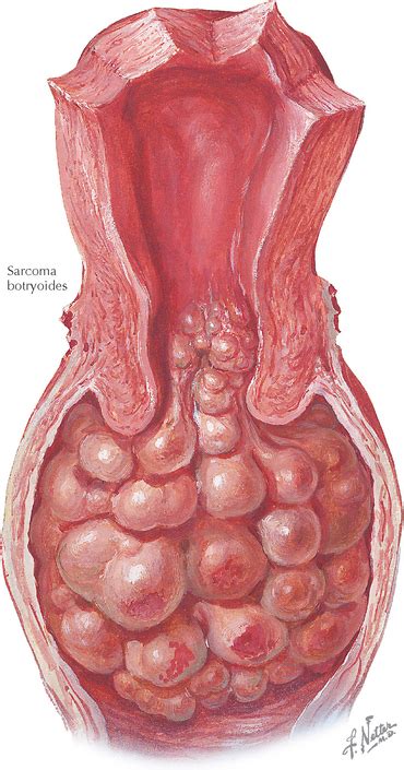 Sarcoma Botryoides | Obgyn Key