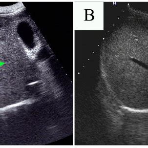 Abdominal ultrasound results before and after the first therapy. (A ...