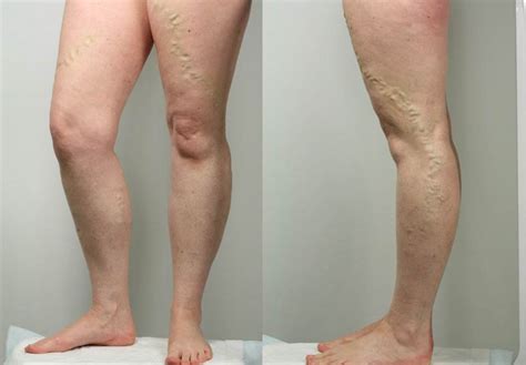 Symptoms of varicose veins in legs | Symptoms and pictures