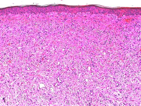 Atypical Fibroxanthoma Histology