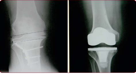 Figure 1 from Total knee arthroplasty following high tibial osteotomy ...