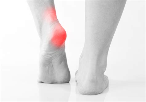 Plantar Fasciitis: Early Treatment is Key to Relief