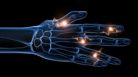 Rheumatoid Arthritis Flares: Causes, Treatments, Prevention | Everyday ...