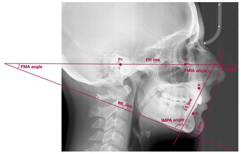 JPM | Free Full-Text | Personalized Orthodontics: From the Sagittal ...