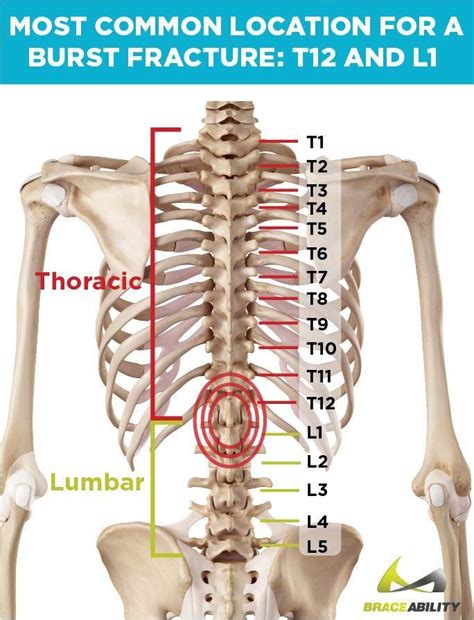 What Does it Mean If I’ve Been Diagnosed with a T12 or L1 Vertebral Burst Fracture?