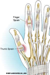 Sprained Finger | treatment, taping and recovery with P.R.I.C.E principle