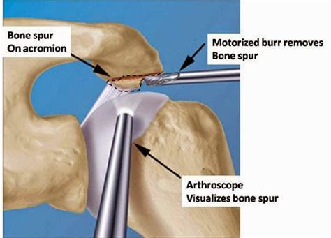 Medical Treatment Pictures-for Better Understanding: Shoulder Synovectomy Surgery: Before ...