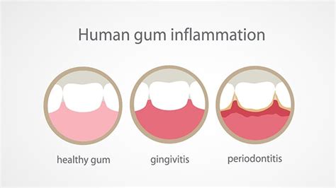 Gum Swelling Treatment - Dental Emergencies