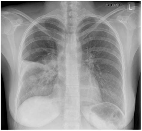 Chronic Obstructive Pulmonary Disease Exacerbations |… | Relias Media