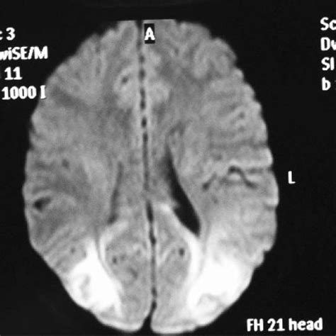 (PDF) SSPE-Case Report