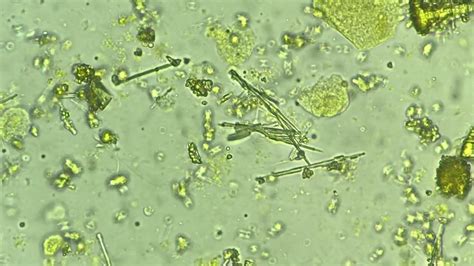 Calcium Phosphate Crystals In Urine