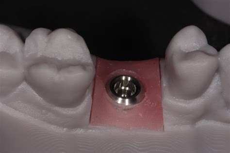 The benefits of tissue level implants restoratively - ITI Blog