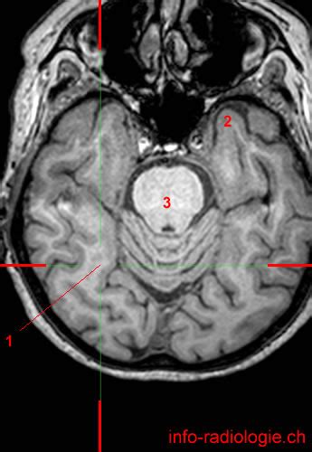 Occipital lobe (MRI)