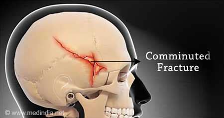 Basal Skull Fracture Complications Symptoms