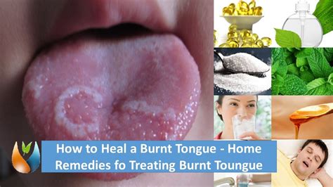 How to Heal a Burnt Tongue - Home Remedies fo Treating Burnt Toungue - YouTube