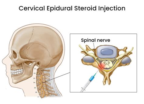 Cervical Epidural Steroid Injection NJ & NYC