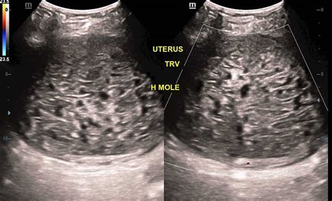 Hydatidiform mole meaning, causes, signs, symptoms, diagnosis & treatment