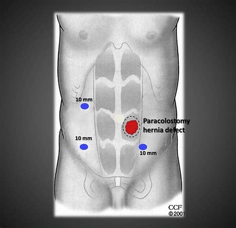 A New Combined Technique of Reinforced Parastomal Hernia Repair - Journal of the American ...