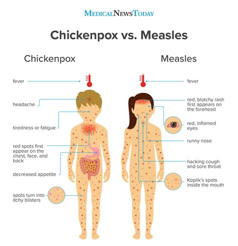 Chickenpox vs. measles: Symptoms, pictures, treatment, and more