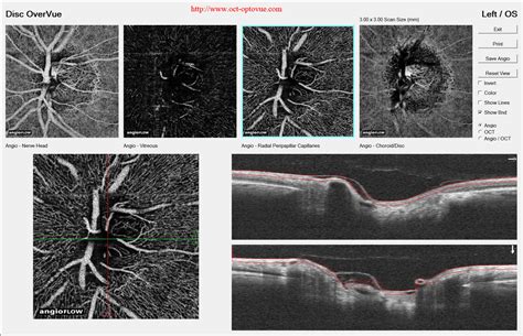 OCT angiography