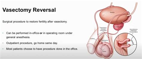 Vasectomy Reversals Just as Successful in Men Over 50 - Z Urology