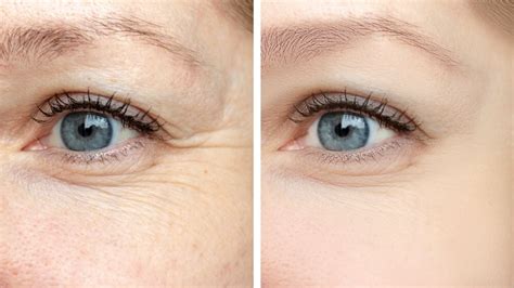 Does Botox for Crows Feet Look Natural? | Siti Med Spa