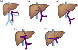 Portosystemic Shunts - TIPSS, Transjugular Intrahepatic Porto-Systemic Shunt ... : Transjugular ...