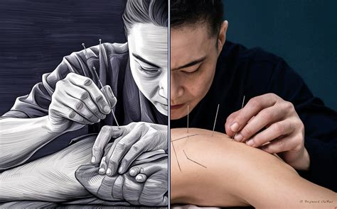 Dry Needling vs. Acupuncture: The Key Differences Explained - Krieg Chiropractic Center