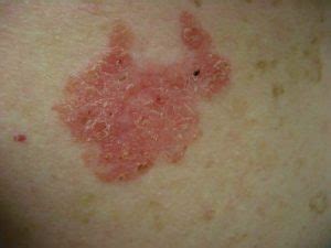 Bowen disease - Toronto Dermatology Centre