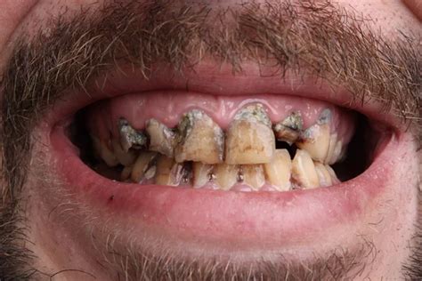 Bad teeth Stock Photos, Royalty Free Bad teeth Images | Depositphotos