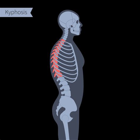 Cervical Kyphosis Treatment in Boston, MA